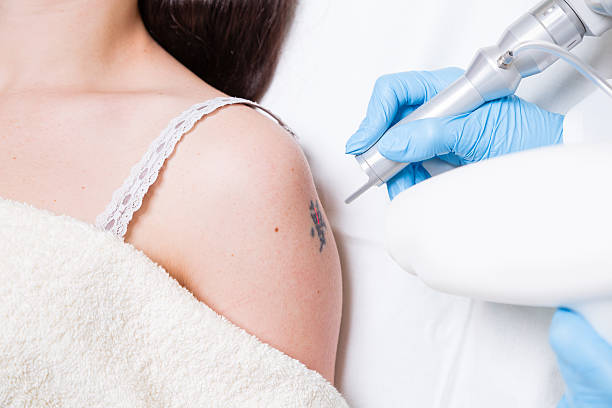 BTBA Beauty & Aesthetics - Laser Tattoo Removal Training Course